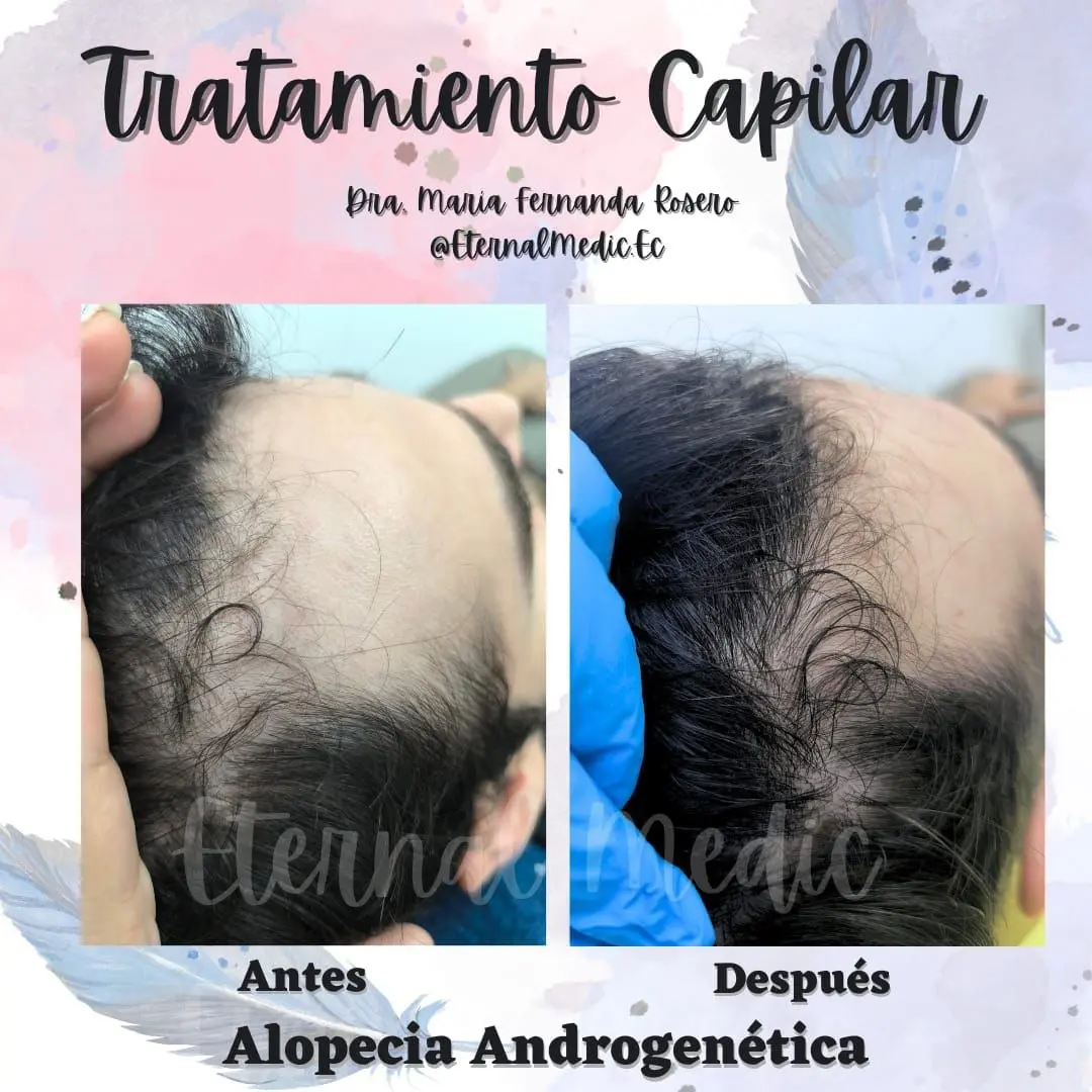 Antes y Después Alopecia Androgenética Masculina