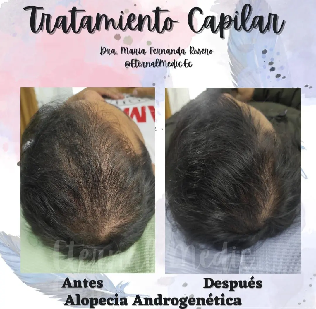 Antes y Después Alopecia Androgenética Femenina
