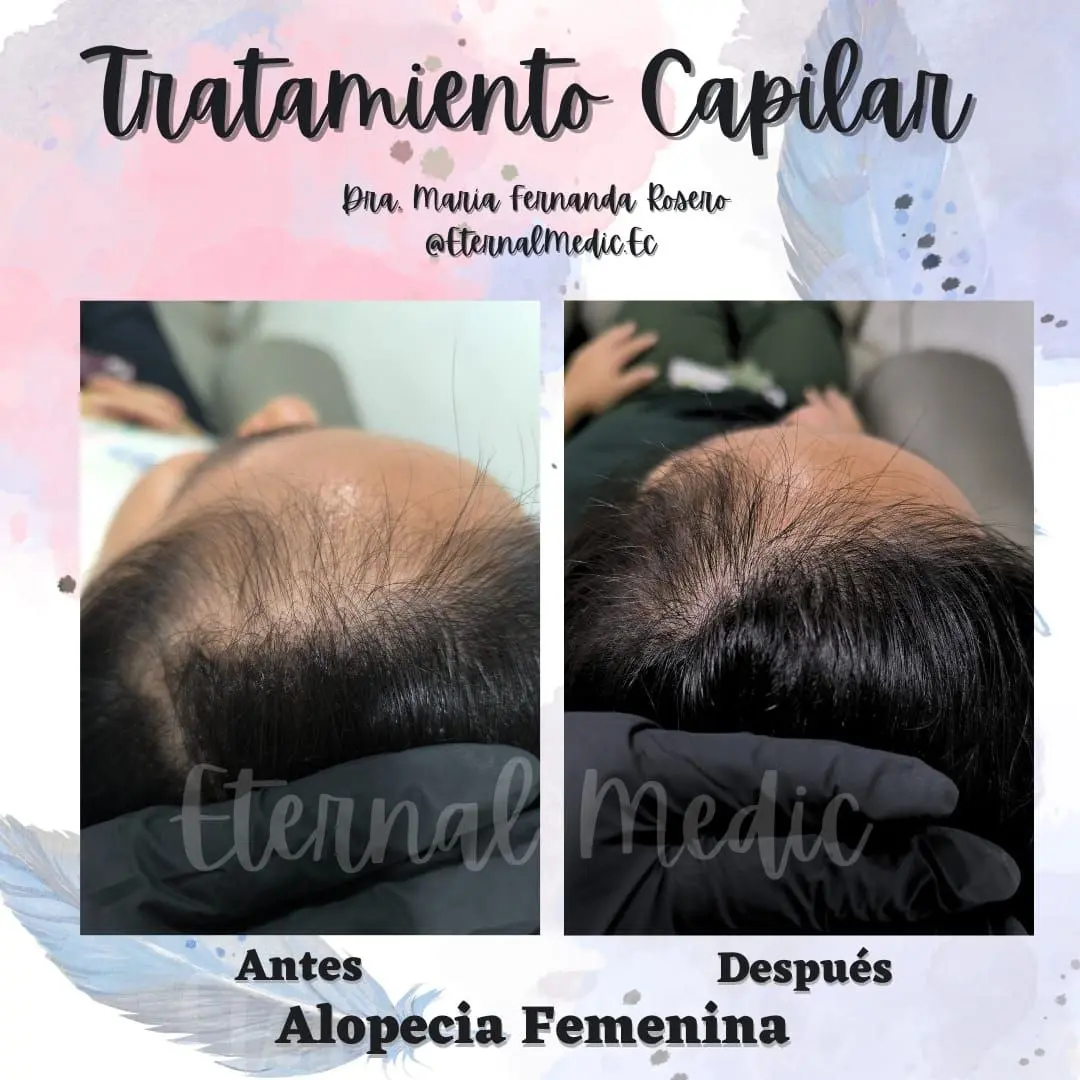 Antes y Después Efluvio Telógeno