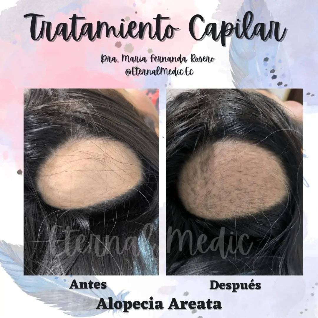 Antes y Después Alopecia Areata Caso 1