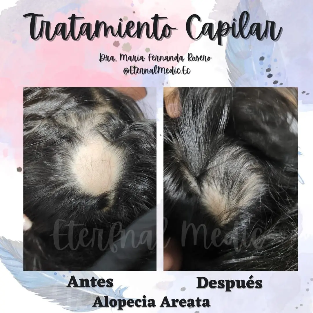 Antes y Después Alopecia Areata Caso 2