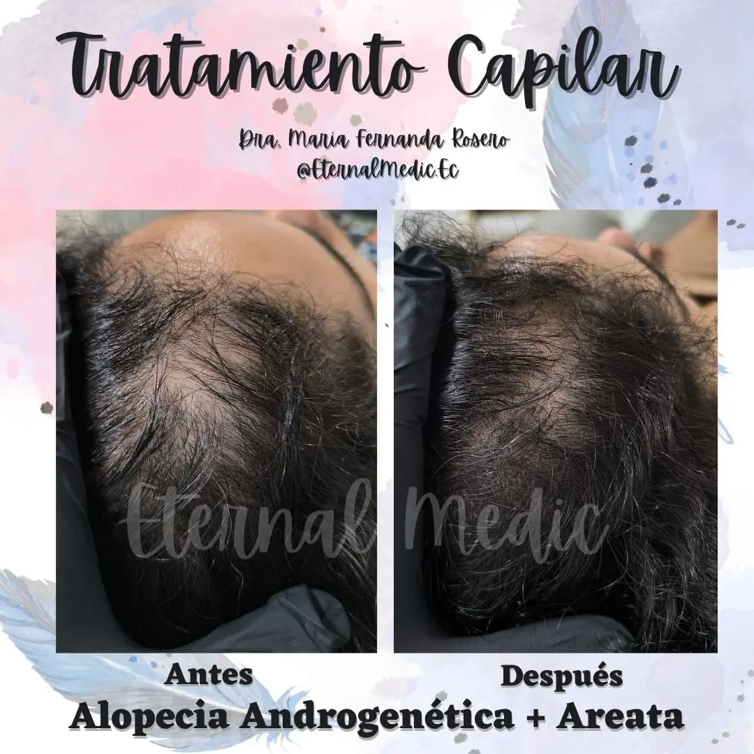 Antes y Después Alopecia Areata en Barba Caso 3