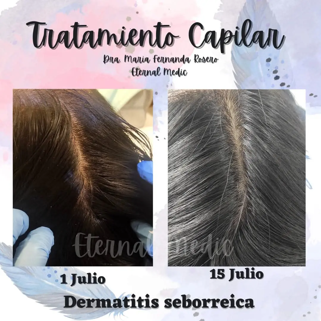 Evolución de tratamiento para descamación capilar