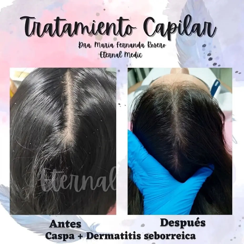 Evolución de tratamiento para caspa en paciente femenina