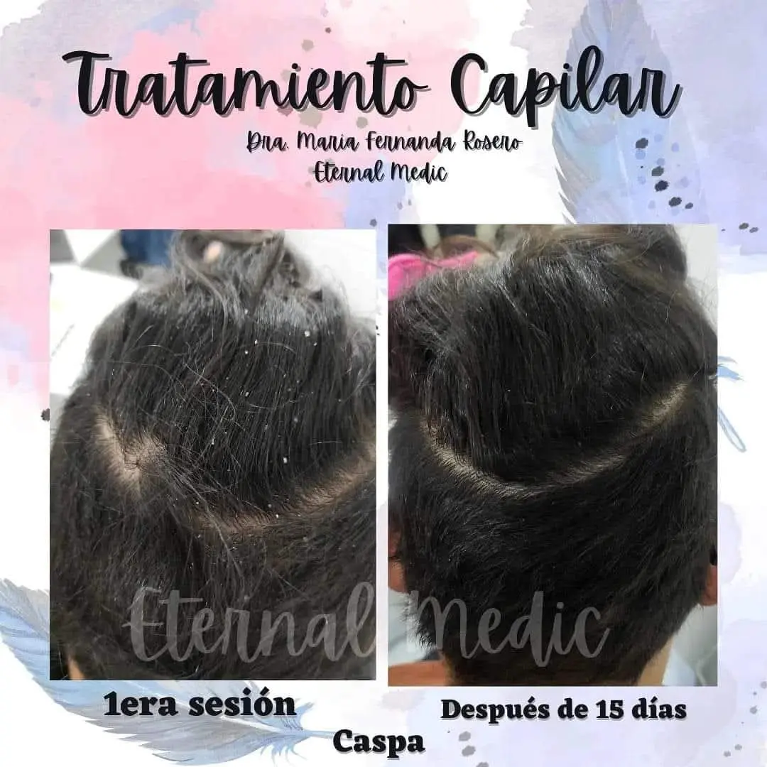 Evolución de tratamiento para caspa en paciente masculino