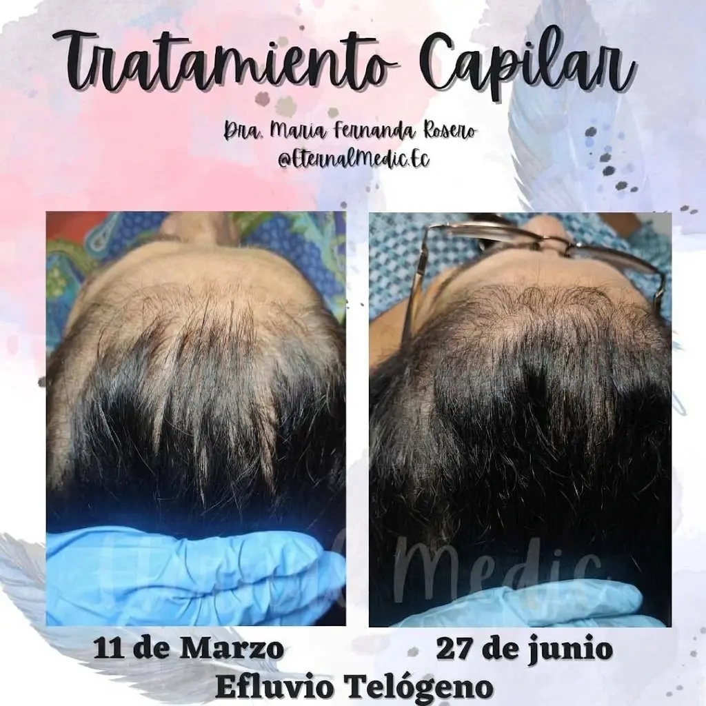 Antes y Después Efluvio Telógeno Postparto