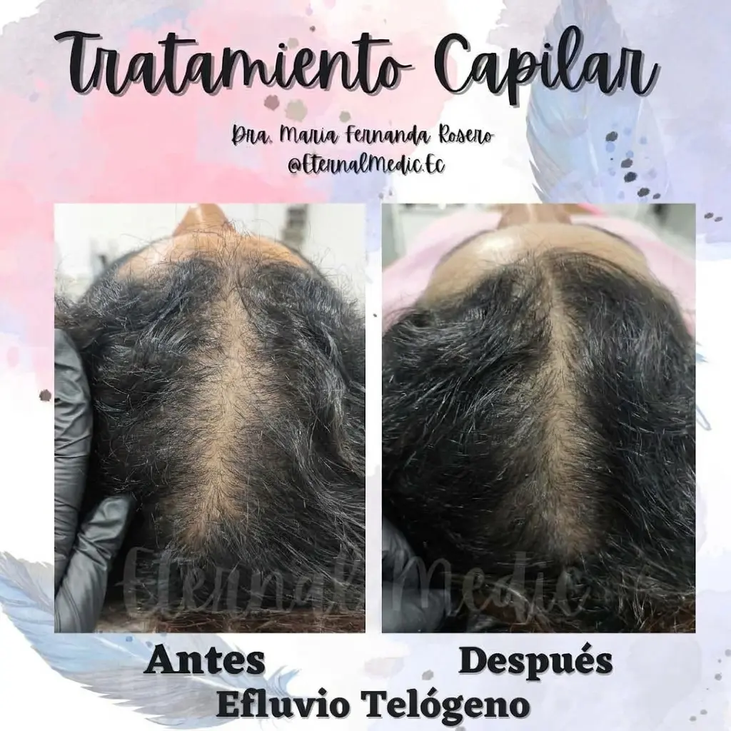 Antes y Después Efluvio por Estrés
