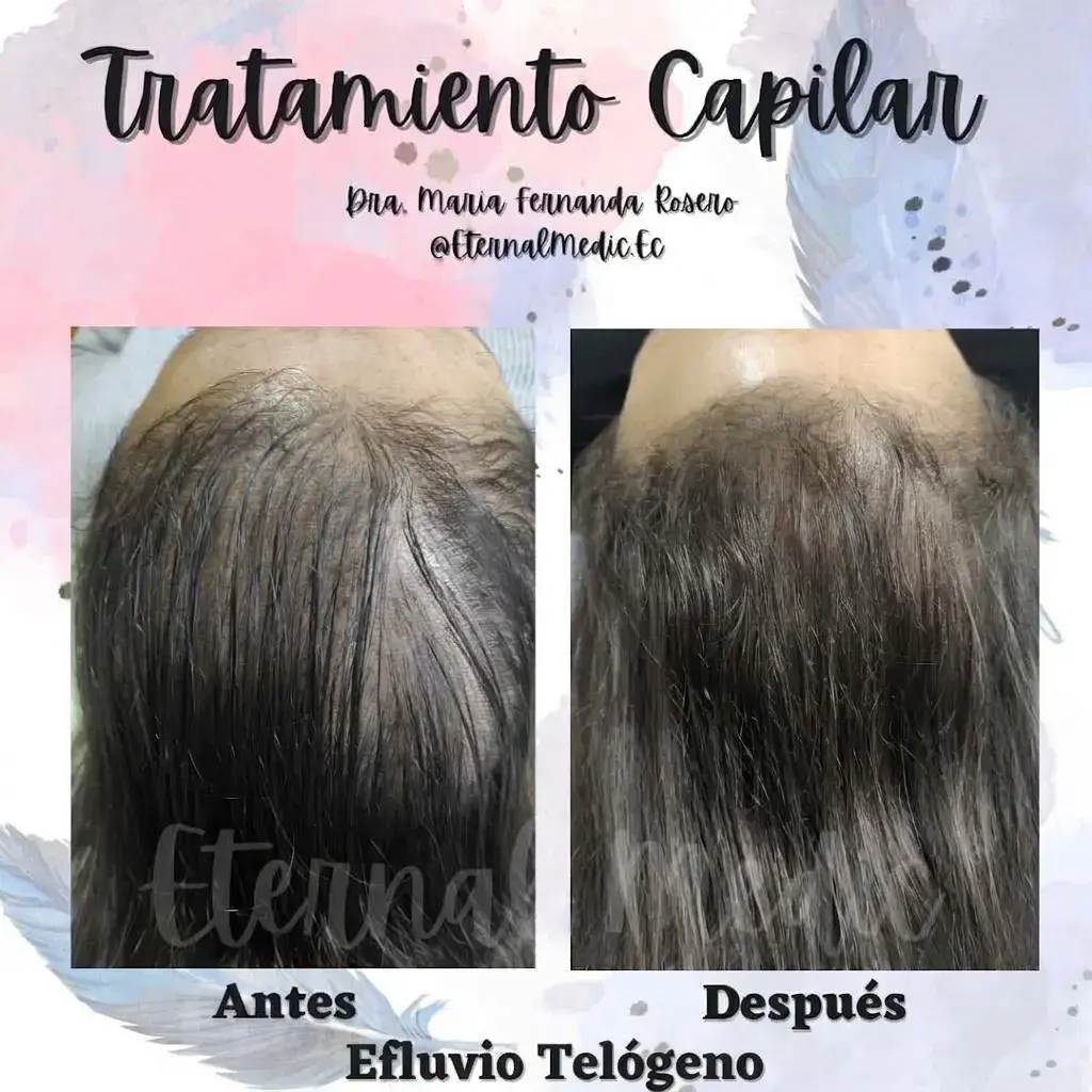 Antes y Después Efluvio Post-Enfermedad