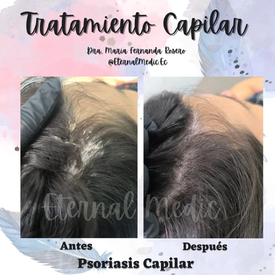 Antes y Después Tratamiento Psoriasis Capilar Caso 3