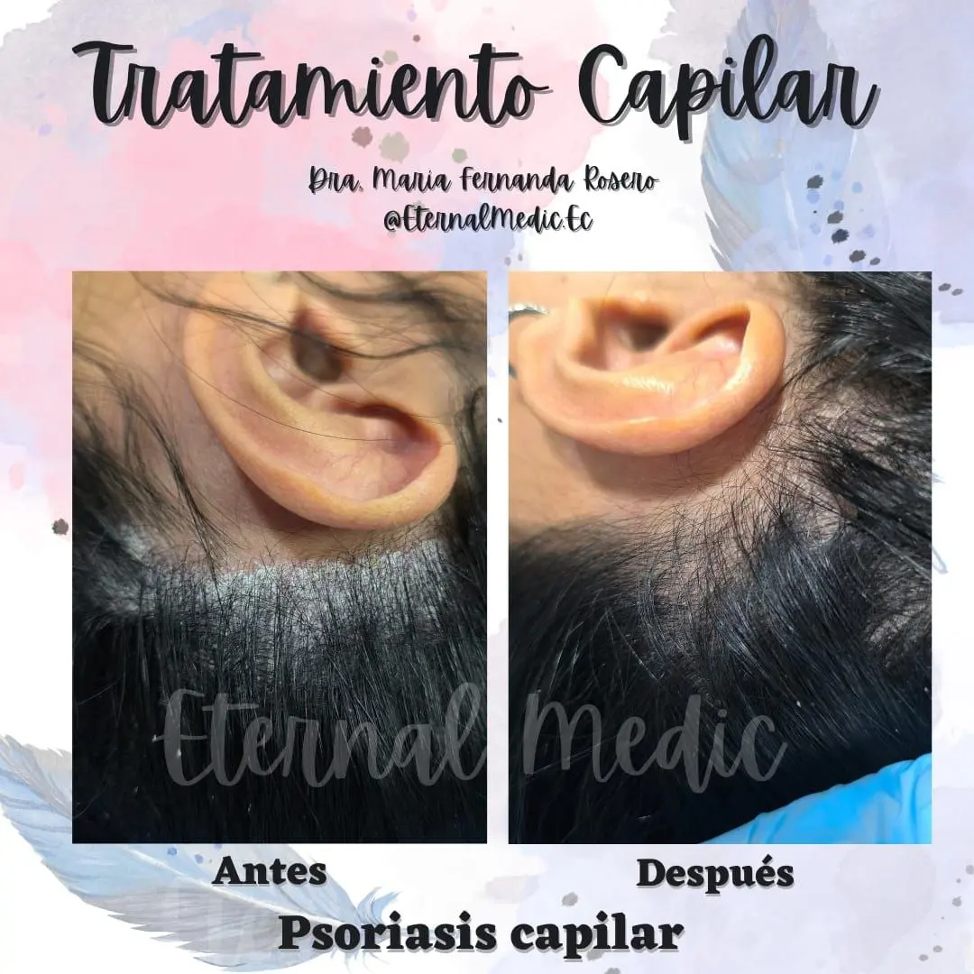 Antes y Después Tratamiento Psoriasis Capilar Caso 2