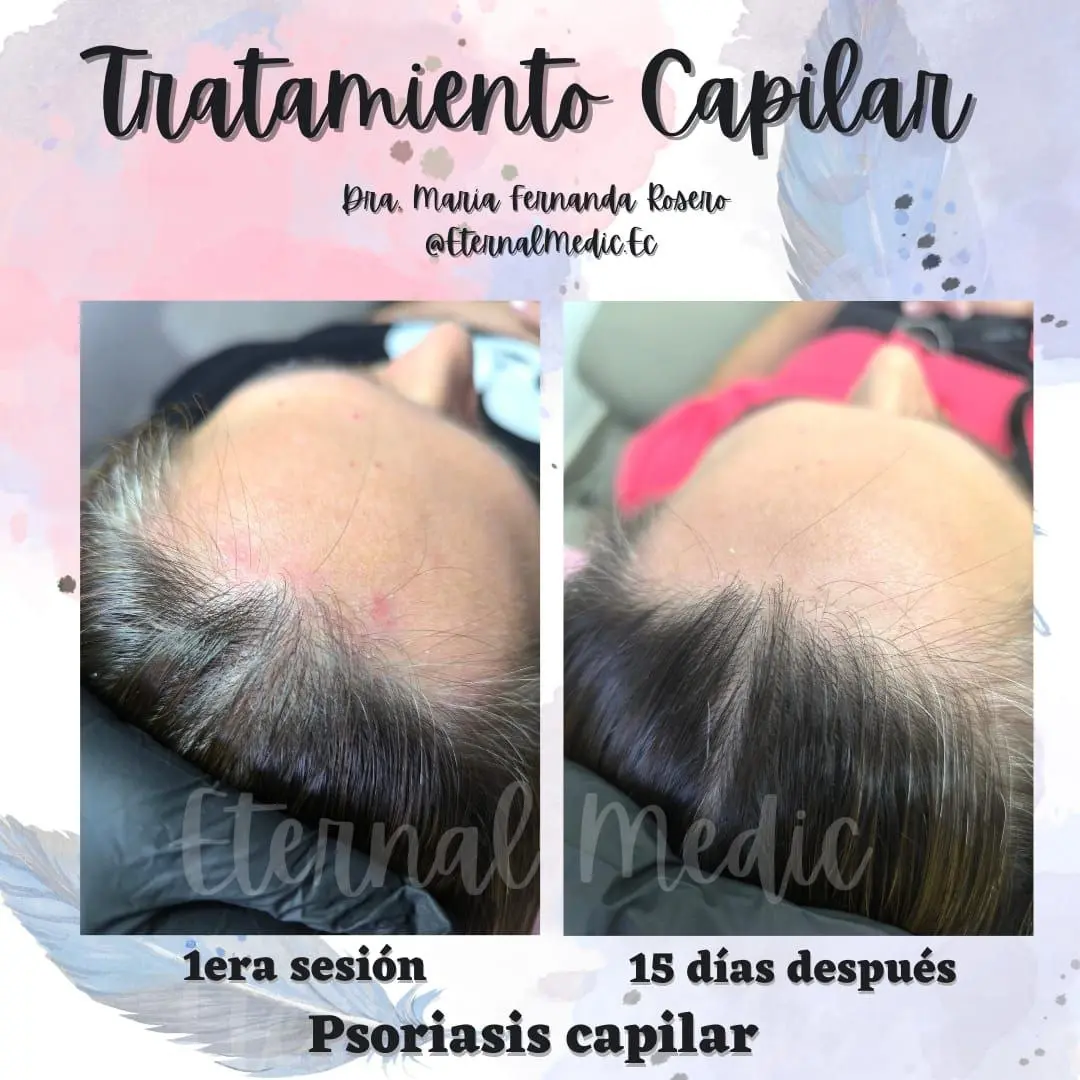 Antes y Después Tratamiento Psoriasis Capilar Caso 1